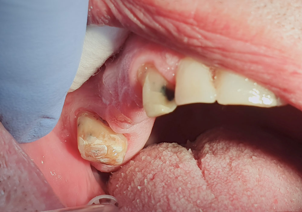 Caso con implantes dentales