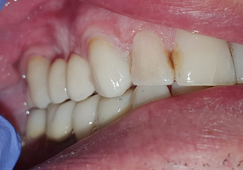 Caso implantes dentales