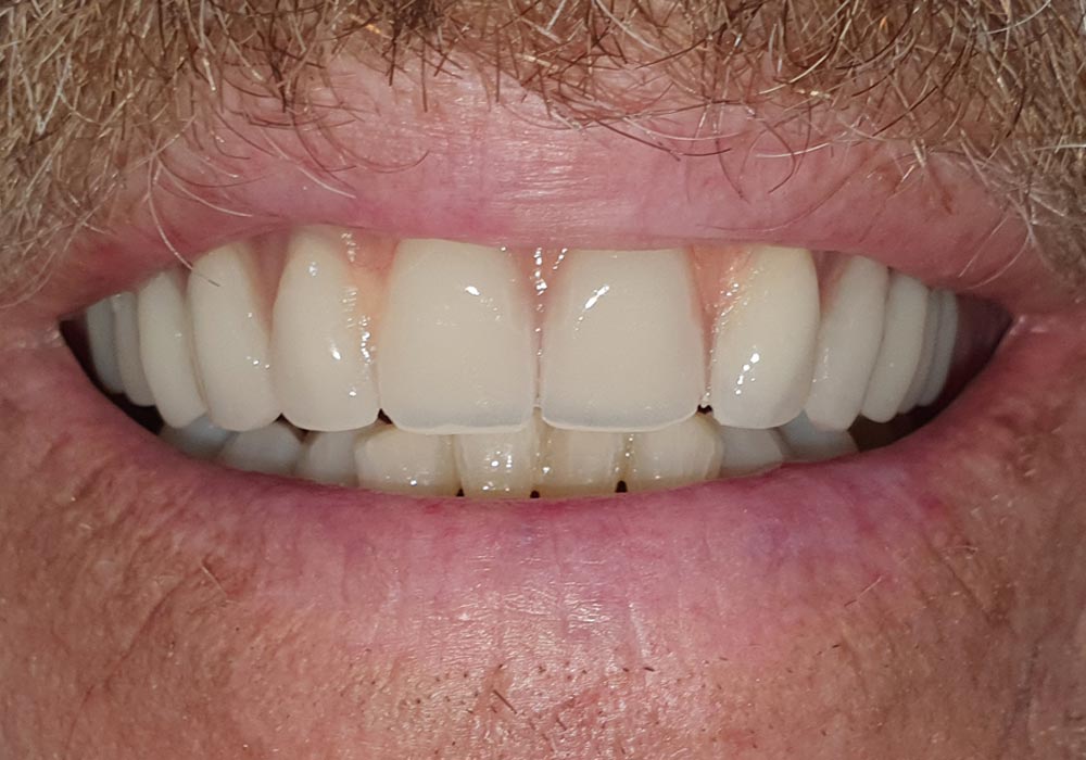 Caso implantes dentales-Después