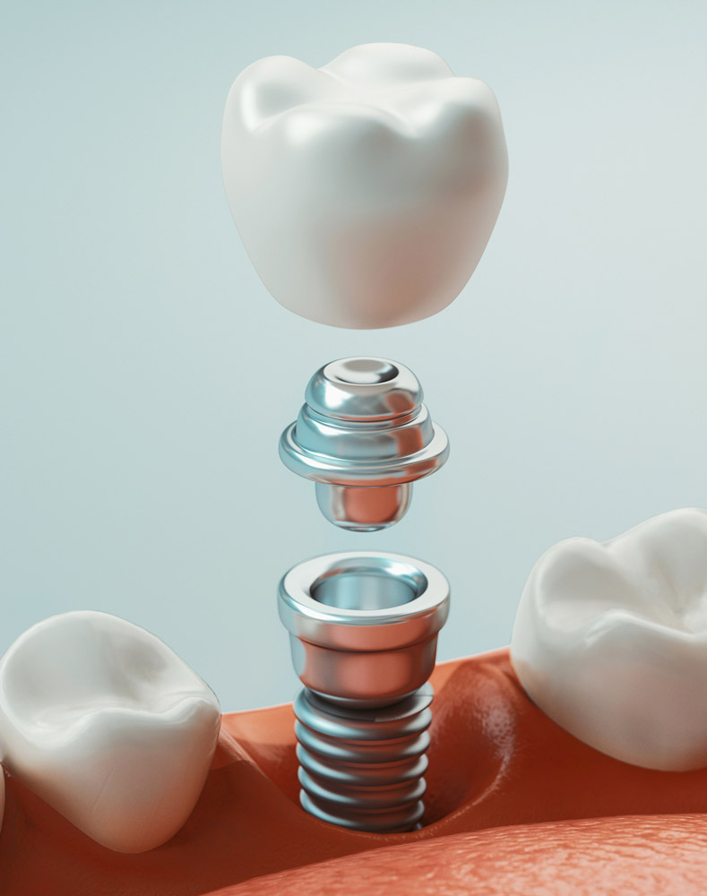 Implantes dentales de carga inmediata Valencia