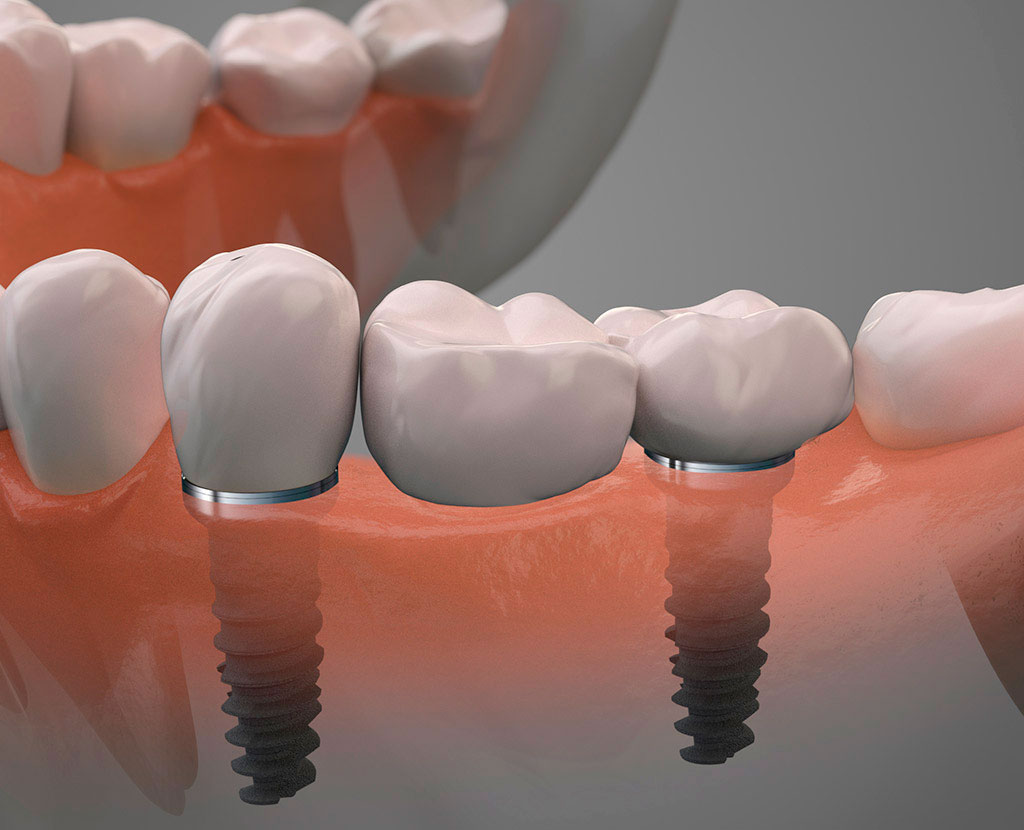 Tratamientos con implantes dentales