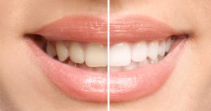 Blanqueamiento dental: antes y después