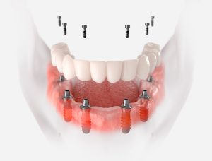 Dentadura sobre implantes