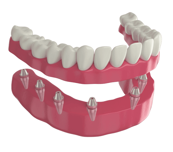 que es una prótesis sobre implantes